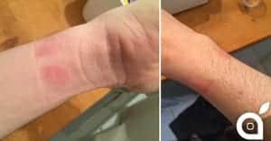 Apple Watchが皮膚アレルギーを引き起こす、Appleはユーザーが正しく着用していない可能性があると述べる