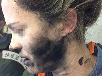 une femme subit des brûlures après l'explosion d'écouteurs à batterie en plein vol -